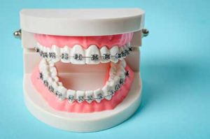 A model of dental braces in tx sits in a dentist's office