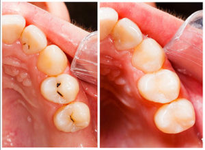 before and after images of dental fillings and sealants in sharpstown tx