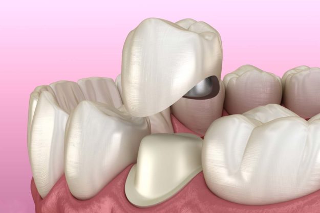 types-of-dental-crowns example of dental crowns available