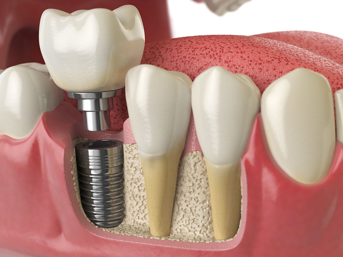 image of dental implants in sharpstown tx makes viewer wonder what are dental implants