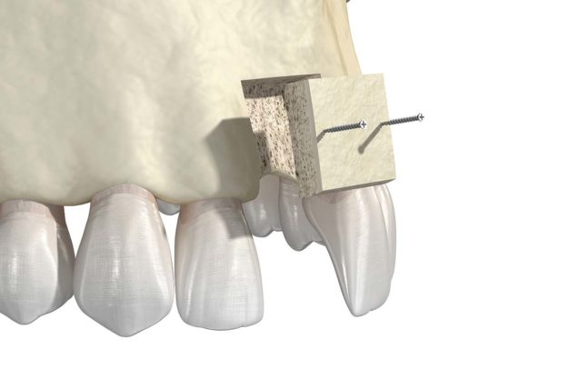 a 3d model of a bone grafting