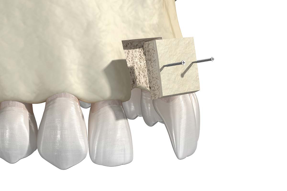 a 3d model of a bone grafting