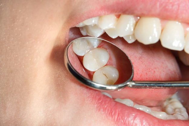 a dentist applying dental sealants