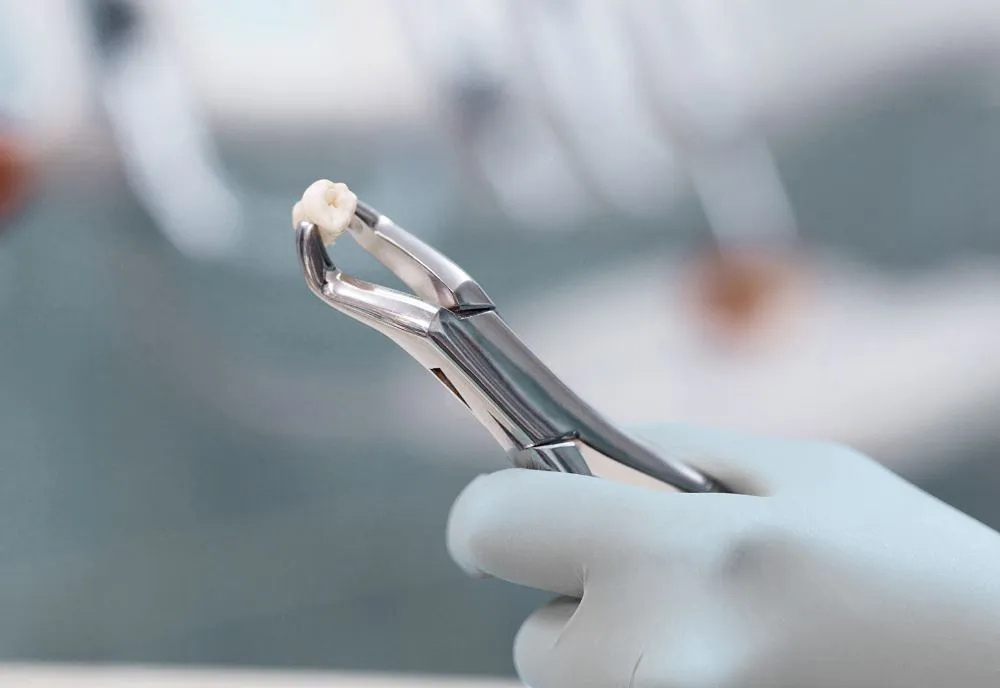wisdom-tooth-extraction