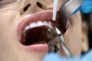 a woman undergoing Tooth Extraction